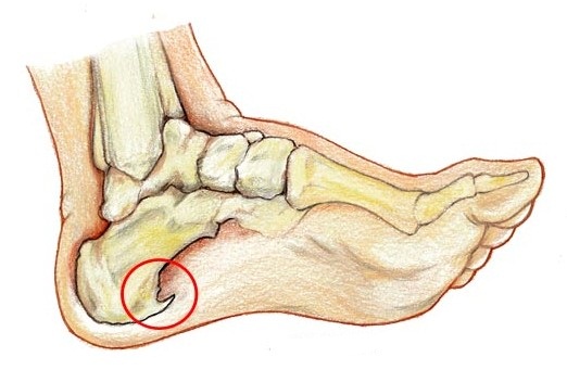 علت داشتن خار پاشنه علت داشتن خار پاشنه