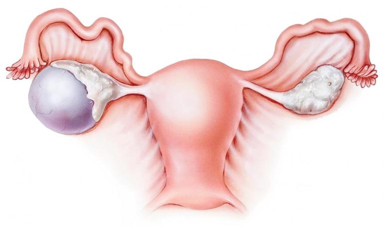 آیا کیست هموراژیک خطرناک است آیا کیست هموراژیک خطرناک است