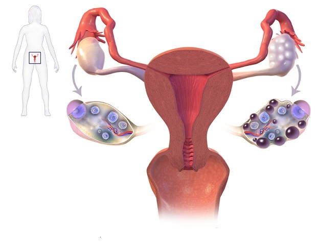 انواع کیست تخمدان