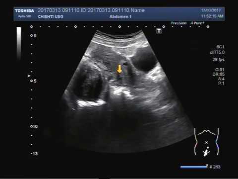 علت کلدوساک یا مایع آزاد در لگن چیست؟ علت کلدوساک یا مایع آزاد در لگن چیست؟