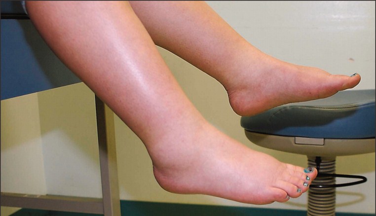 ورم پا و علت آن