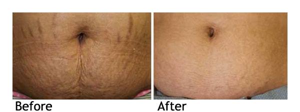 اثربخشی کربوکسی تراپی اثربخشی کربوکسی تراپی