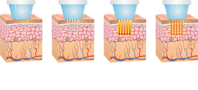 دستگاه ار اف فرکشنال رادیوفرکانسی