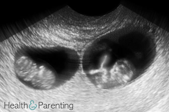 سونوگرافی دوقلویی