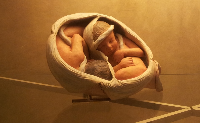 علائم بارداری دوقلویی