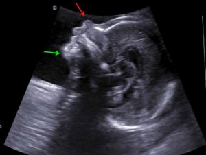 تصویر پیشانی در سونو آنومالی