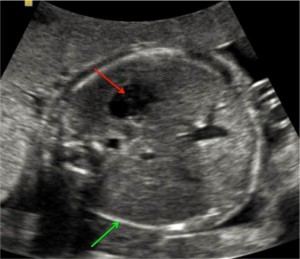 مقطع عرضی شکم در بارداری