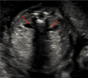 شکم جنین در سونو آنومالی