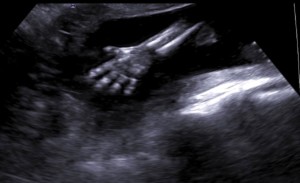 دست جنین در سونو آنومالی