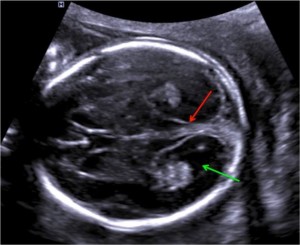سر جنین در سونوگرافی آنومالی