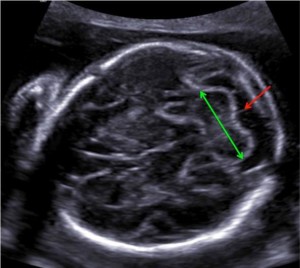 مخچه جنین در سونوگرافی آنومالی