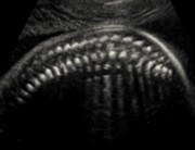 ستون فقرات در سونو آنومالی