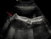 پای جنین در سونو آنومالی