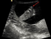 انگشت شست پا در سونو آنومالی