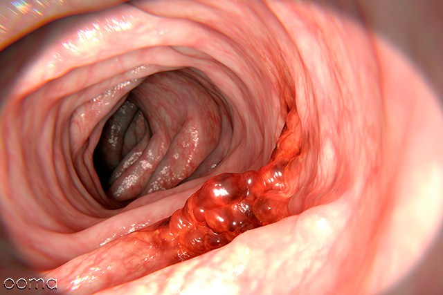 کولونوسکوپی کولونوسکوپی