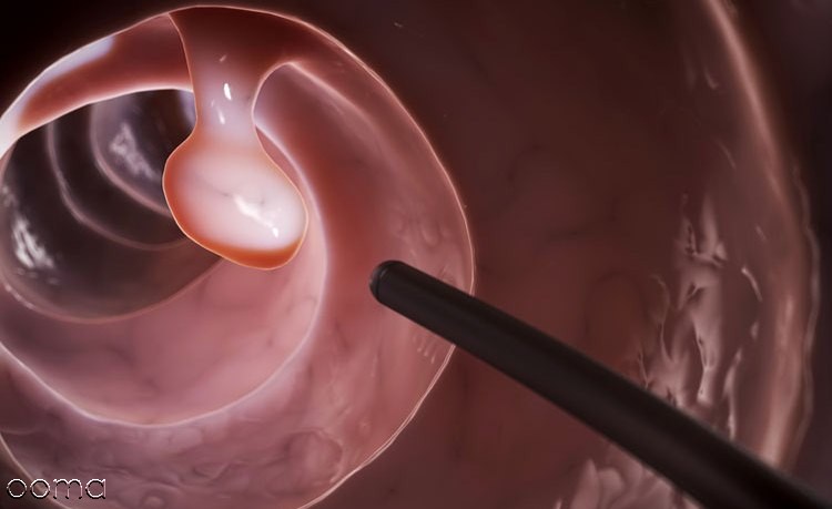 آمادگی قبل از کولونوسکوپی آمادگی قبل از کولونوسکوپی