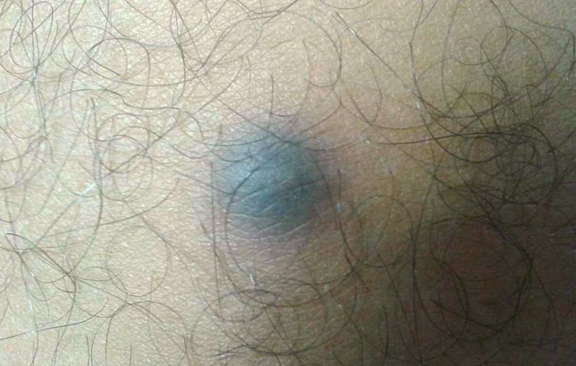 درماتوقیبروما