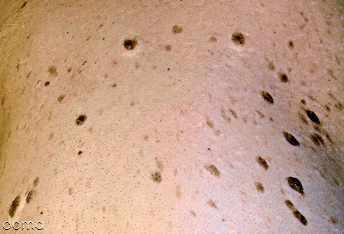 کراتوز سبوره ای