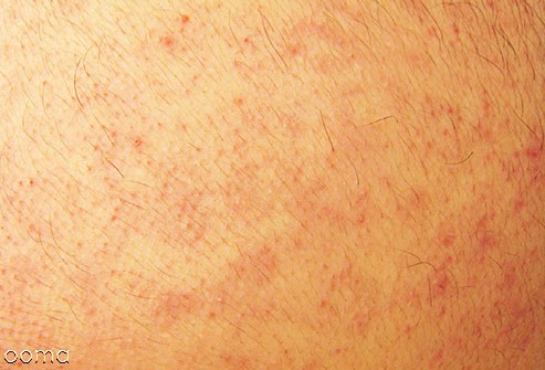 کراتوز پیلاری