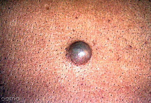 درماتوفیبروما