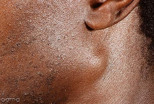 تورم غدد لنفاوی