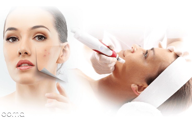 مراقبت های بعد از میکرونیدلینگ