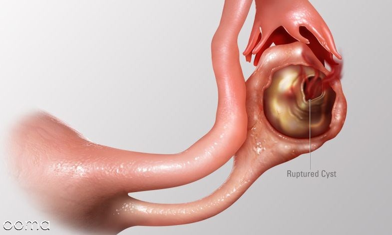 ترکیدن کیست تخمدان ترکیدن کیست تخمدان