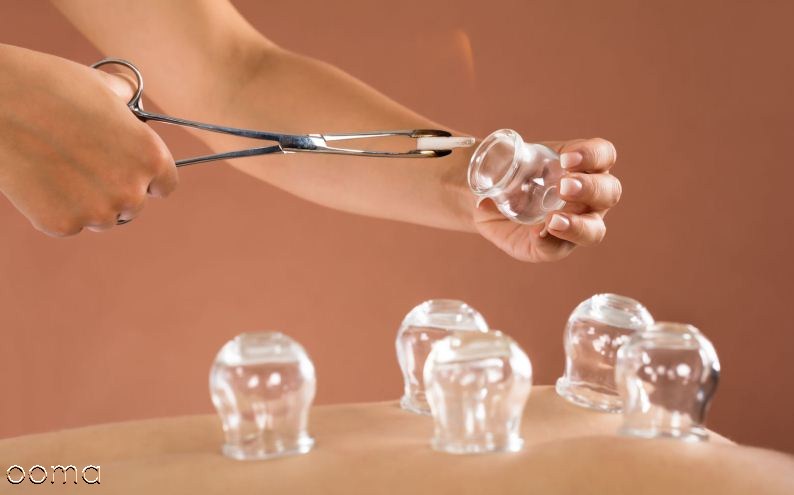 هنگام حجامت چه باید کرد