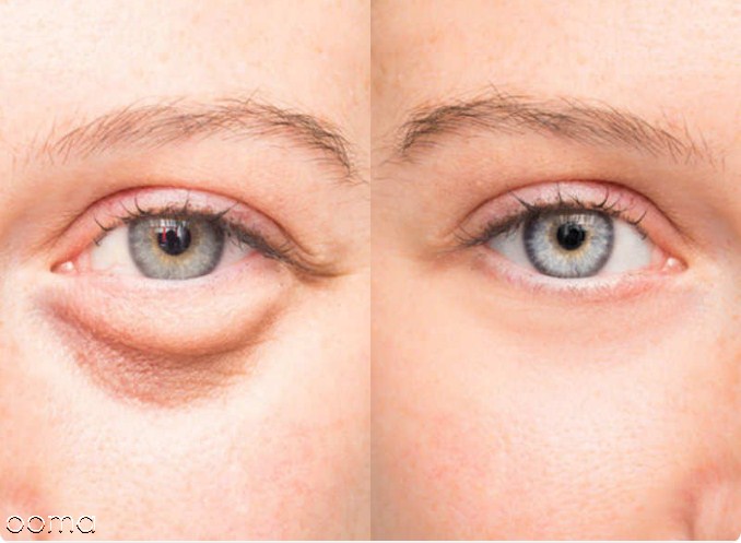 درمان پف و سیاهی دور چشم