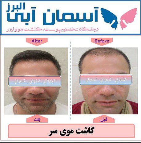 روش های کاشت مو روش های کاشت مو