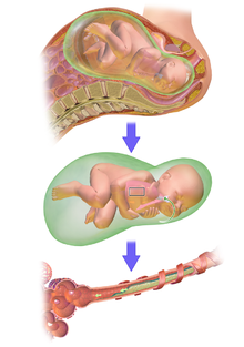 مکیدن مدفوع جنین