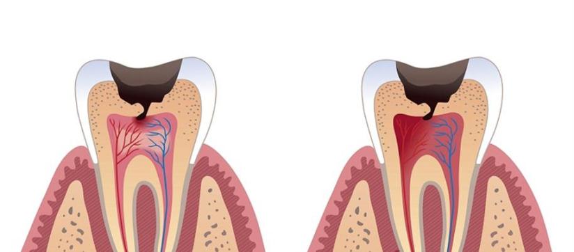 عوارض پوسیدگی دندان عوارض پوسیدگی دندان