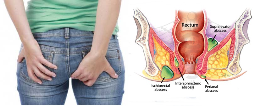 دلایل خارش و سوزش مقعد دلایل خارش و سوزش مقعد