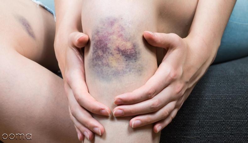 دلایل کبود شدن بدن دلایل کبود شدن بدن