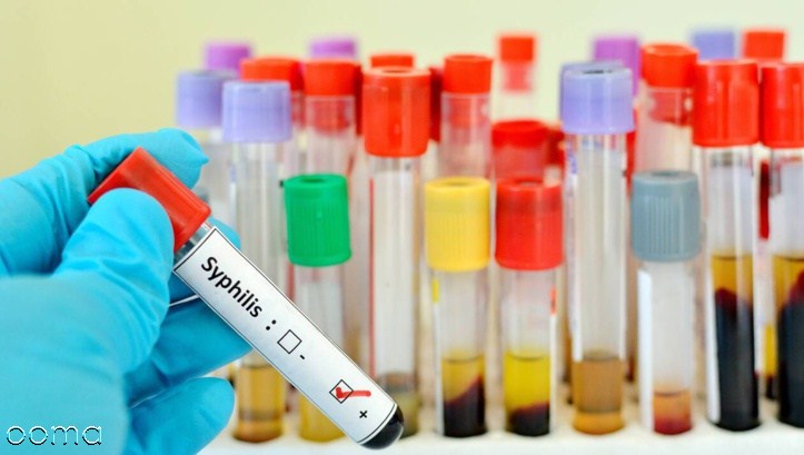 چگونه بفهمیم سفلیس داریم