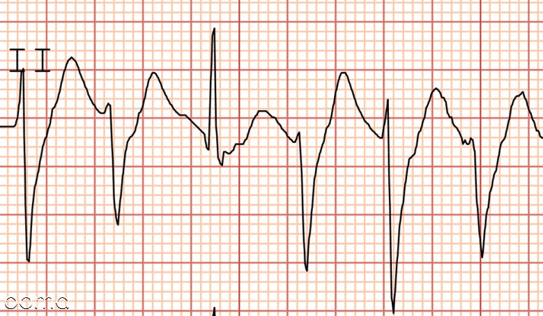 ضربان قلب بالا یا تاکی کاردی