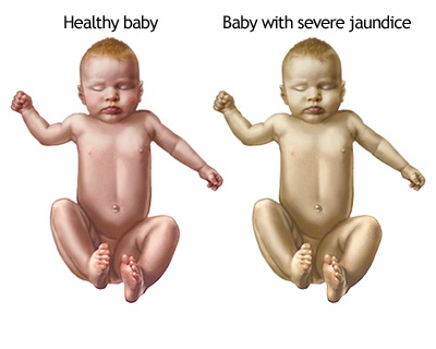 زردی نوزاد زردی نوزاد