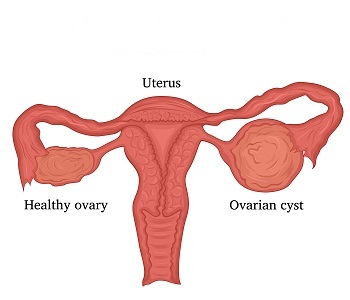 علائم و نشانه کیست تخمدان