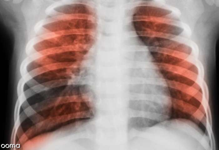 تشخیص عفونت ریه