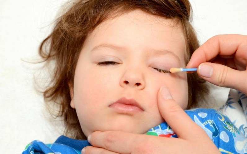 درمان اشک چشم نوزاد