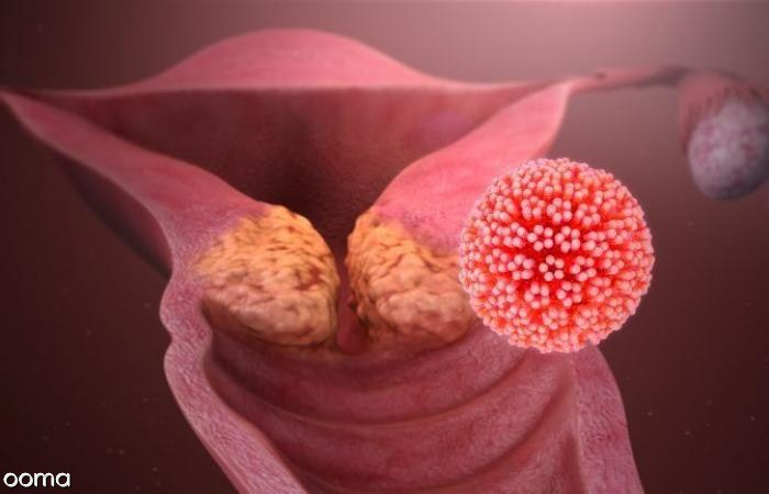 درمان زگیل تناسلی درمان زگیل تناسلی