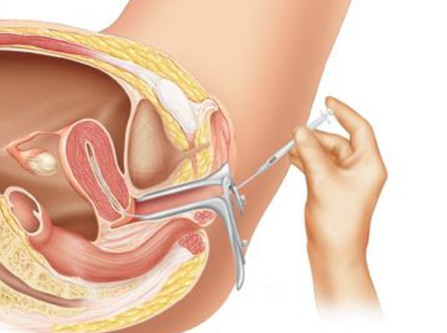 نمونه گیری تست بعد از مقاربت