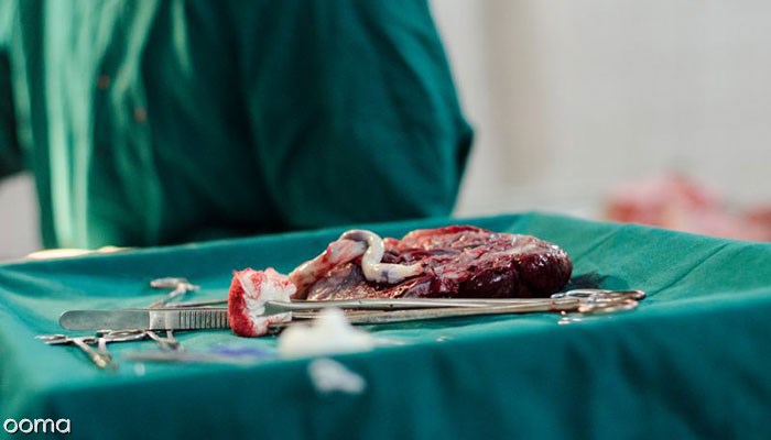 6489-خونریزی-جفت-در-بارداری