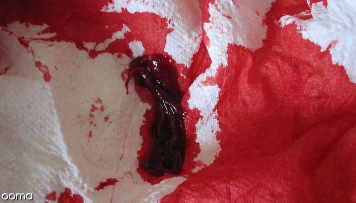 9678-لخته-های-خون-در-پریود