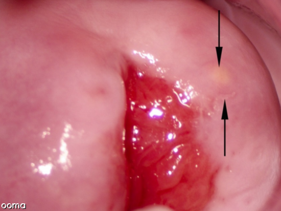 کیست نابوتین کیست نابوتین