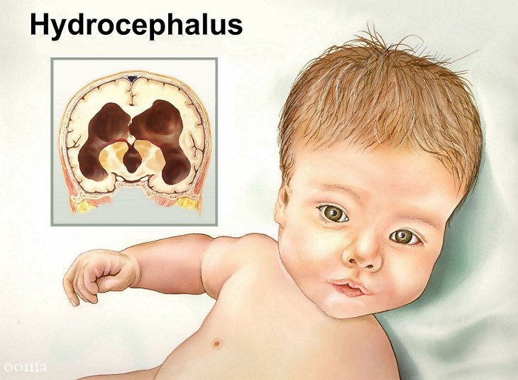 علائم هیدروسفالی