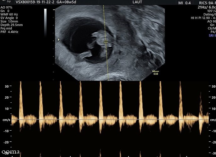 تعیین جنسیت در هفته هشتم بارداری تعیین جنسیت در هفته هشتم بارداری