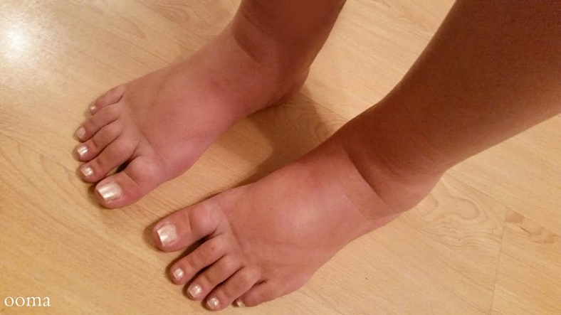 ورم پا در بارداری