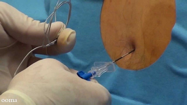 بی حسی اپیدورال