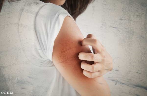 خشکی پوست در بارداری خشکی پوست در بارداری